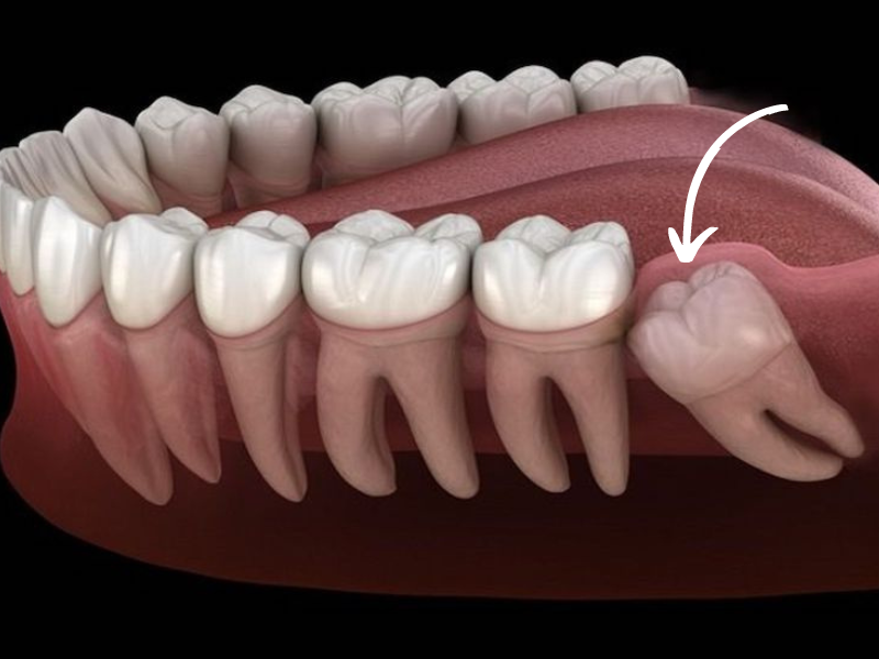 Răng khôn mọc lệch