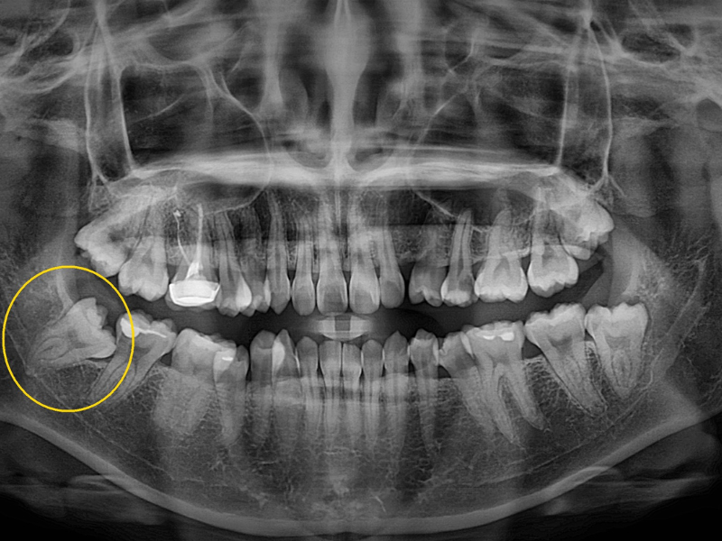 Nhổ răng khôn Thái Nguyên uy tín tại Nha Khoa Bảo Mai