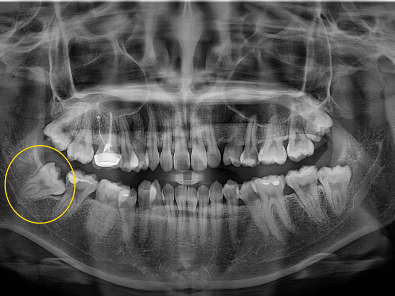 Răng khôn còn có tên gọi khác là răng số 8