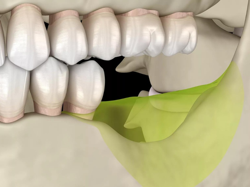 hối hận khi trồng Implant quá muộn