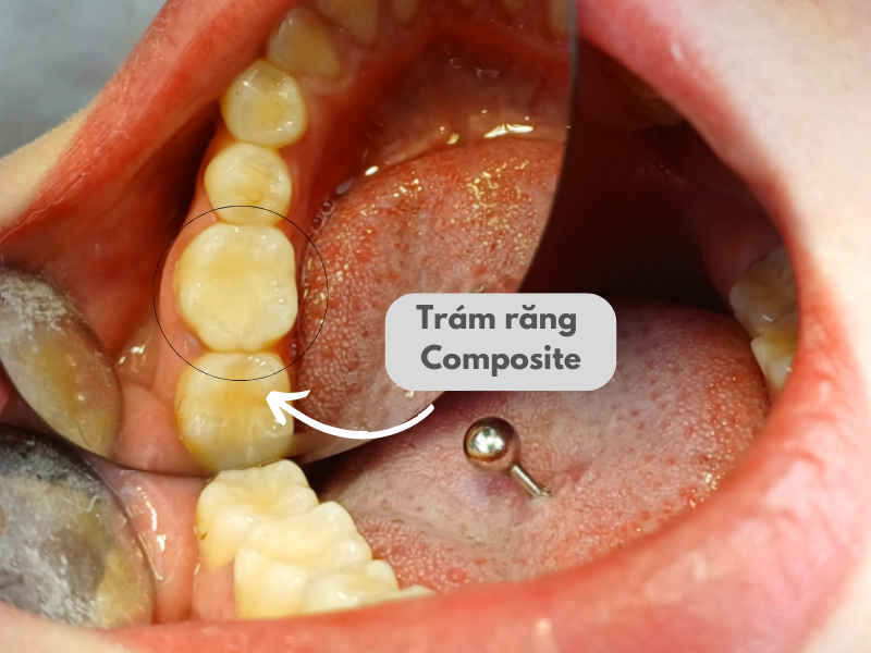 Trám răng thẩm mỹ bằng Composite tại Nha Khoa Bảo Mai