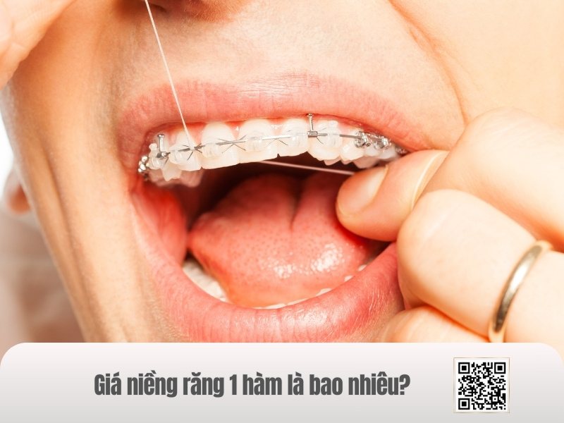 Giá niềng răng 1 hàm