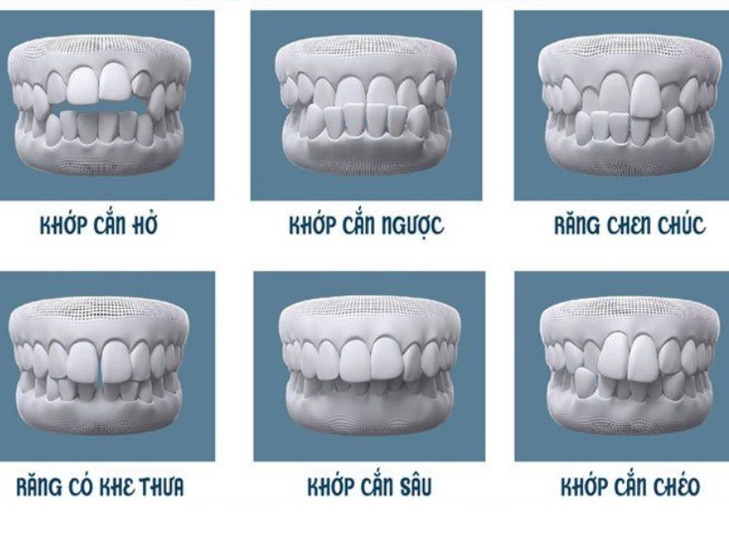 Một số trường hợp nên thực hiện chỉnh nha niềng răng