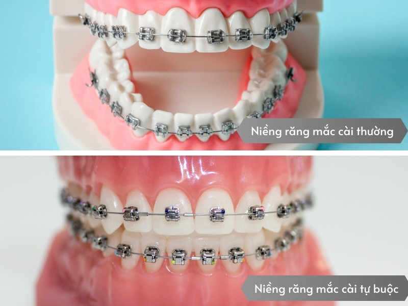 Niềng răng mắc cài tự động 