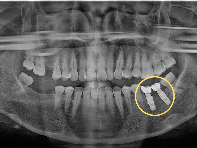 Nhược điểm của trồng răng Implant