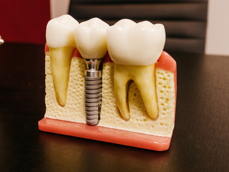 Bảng giá trồng răng Implant tại Thái Nguyên