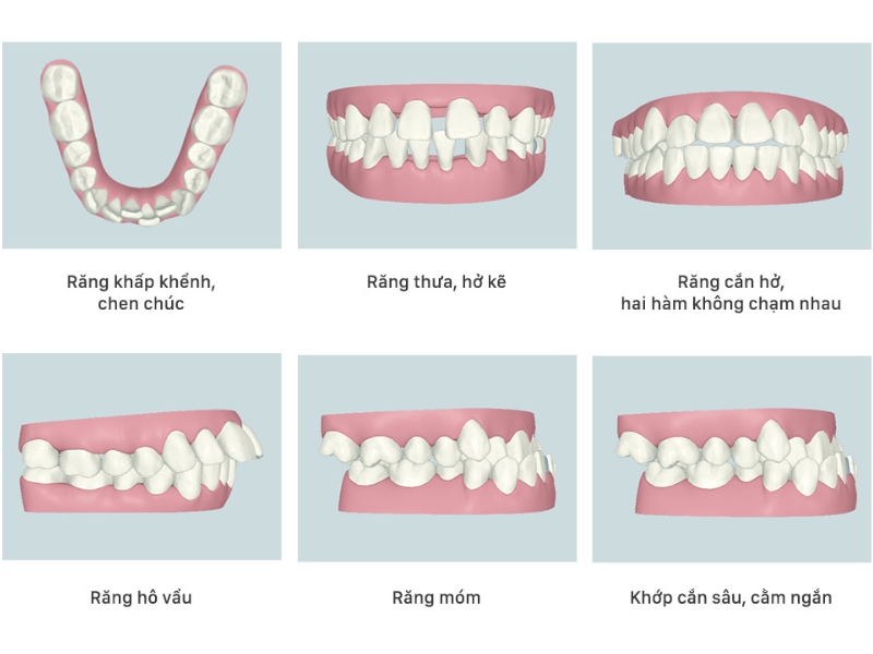 Các trường hợp răng nên chỉnh nha