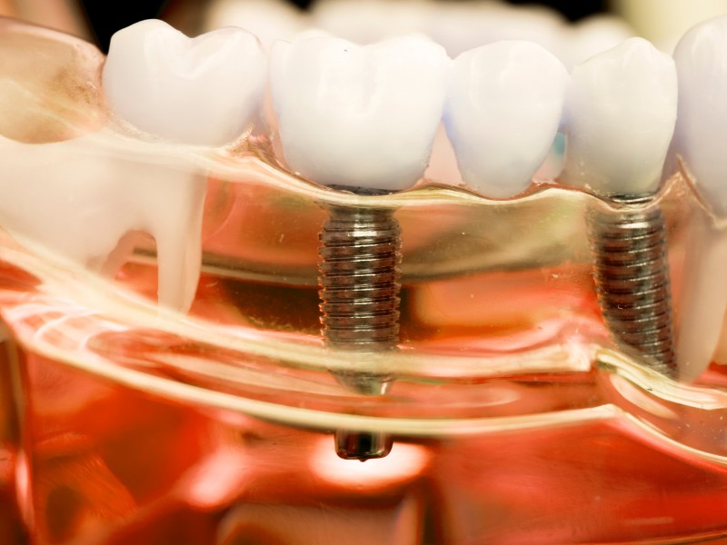 Trồng răng Implant