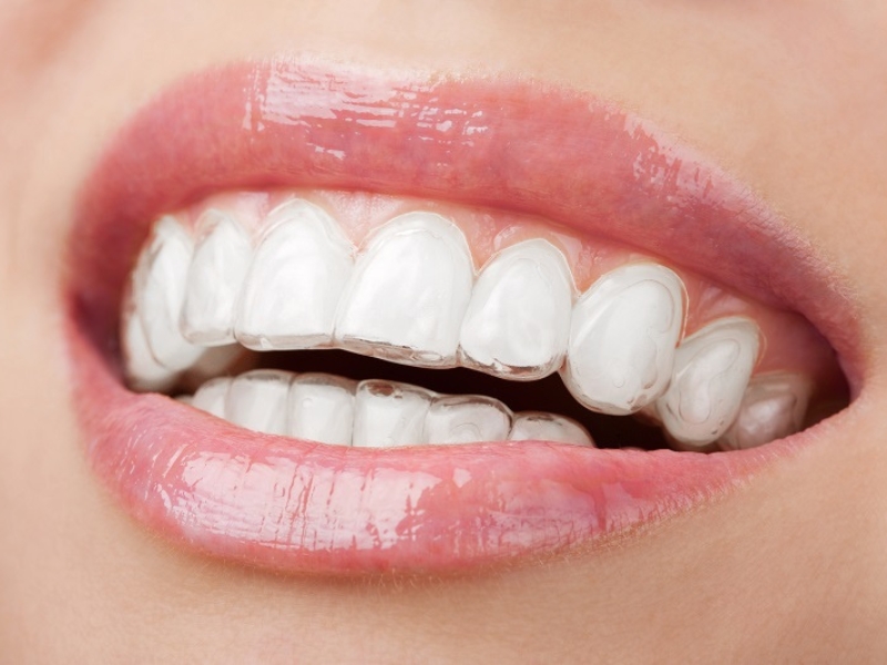 Khay niềng trong suốt Invisalign