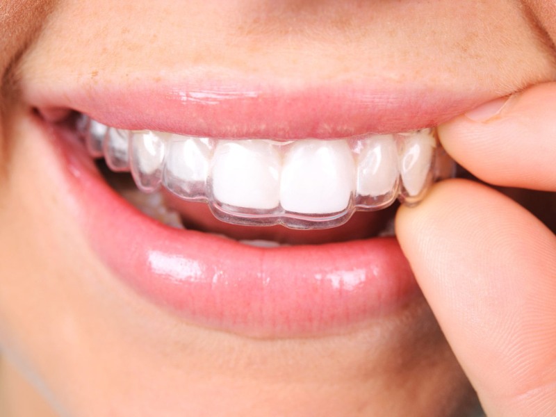 Khay niềng trong suốt Invisalign