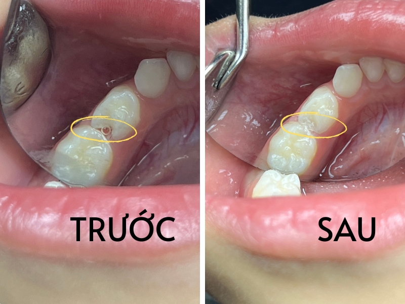 Trám răng sâu ở trẻ nhỏ