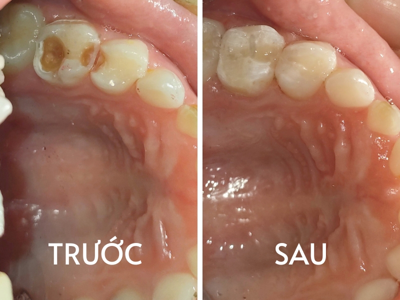 Trẻ em có nên trám răng không