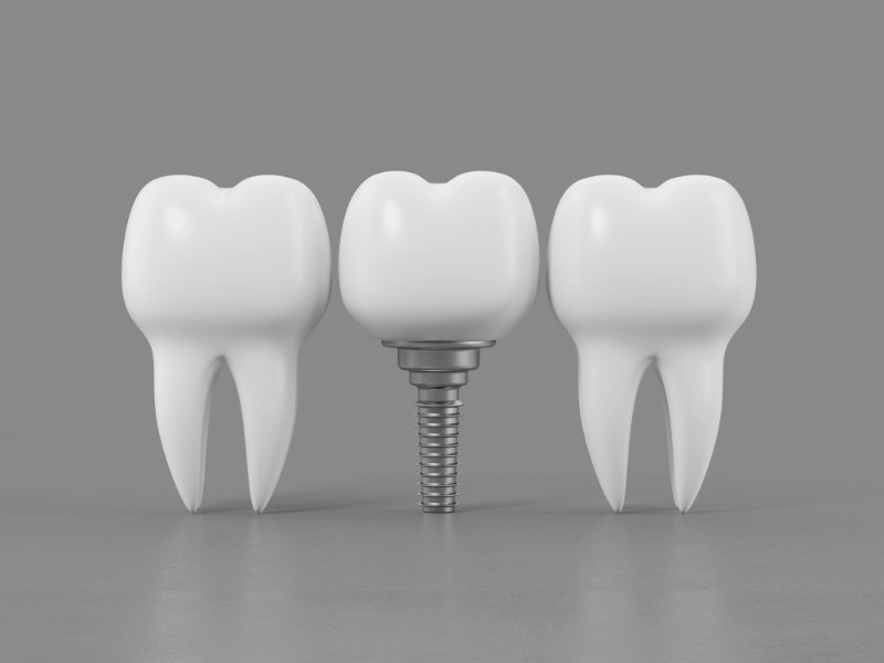 Trồng răng Implant