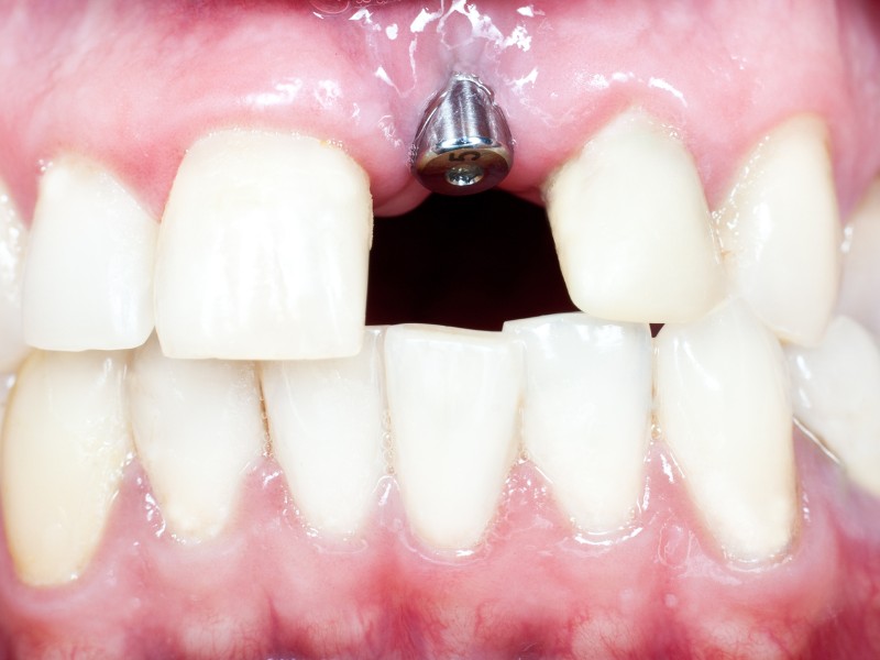 Cấy ghép Implant 