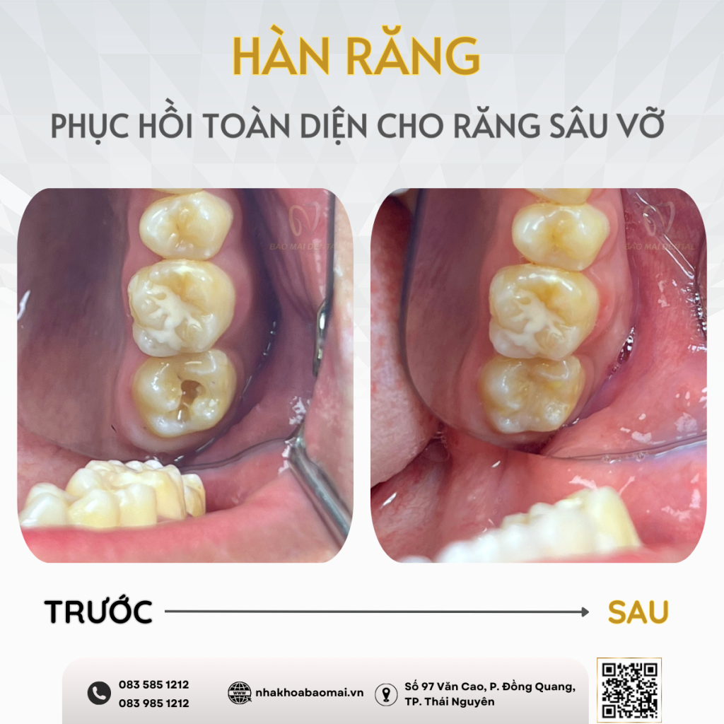 Dấu hiệu bị sâu răng