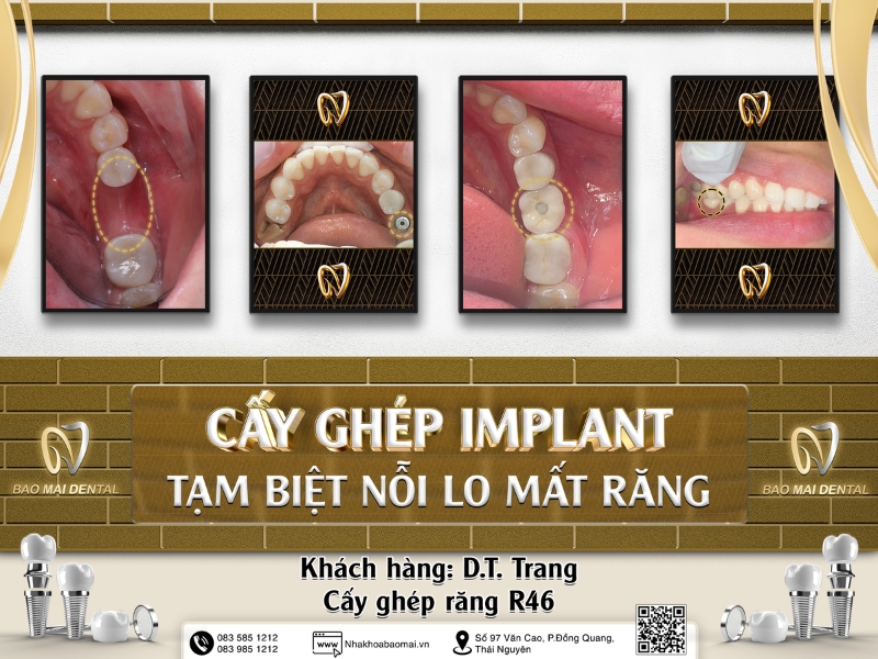 Cấy ghép Implant 