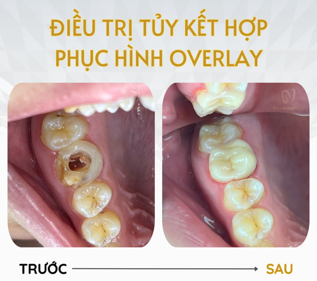 Dấu hiệu sâu răng vào tủy