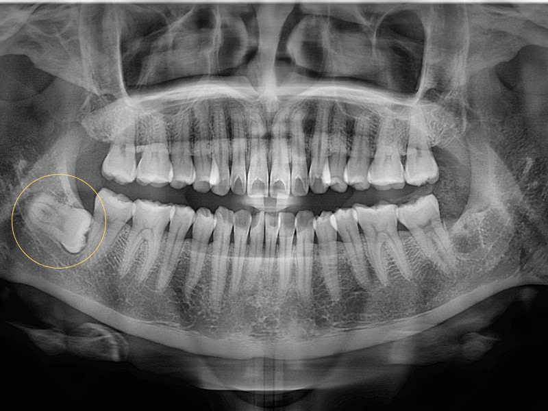 Răng khôn mọc ngầm là một trong những nguyên nhân gây viêm lợi trùm răng khôn