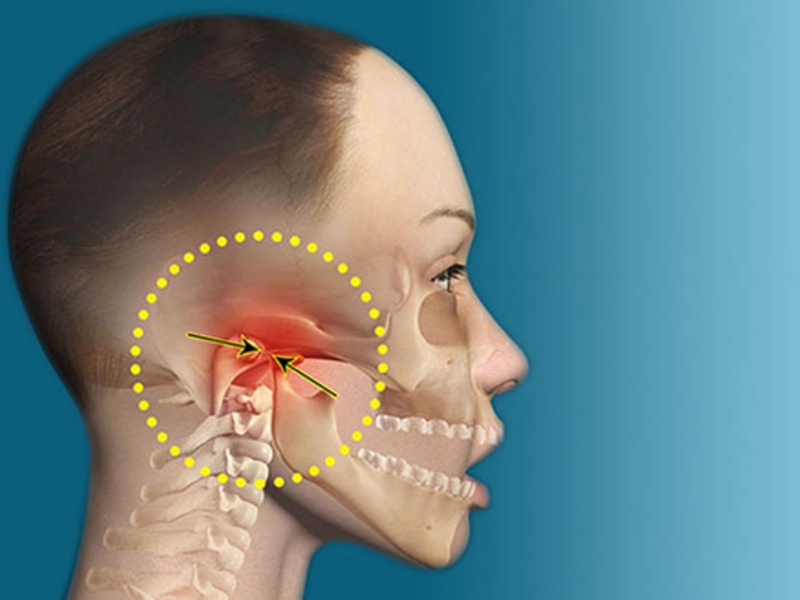 Rối loạn khớp thái dương hàm
