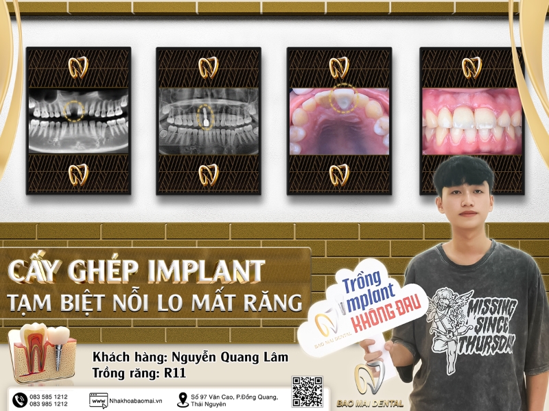 Trồng răng Implant trả lại chức năng ăn nhai hoàn hảo và cải thiện thẩm mỹ gương mặt