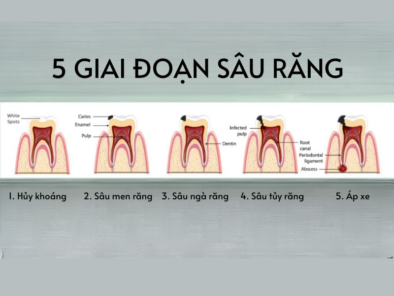 5 giai đoạn sâu răng