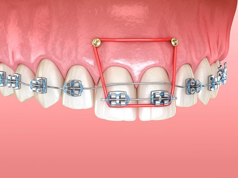 Bắt vít khi niềng răng giúp di chuyển răng hiệu quả hơn trong một số trường hợp 