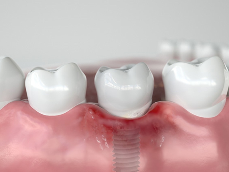 Biến chứng trồng răng Implant có thể xảy ra do nhiều nguyên nhân