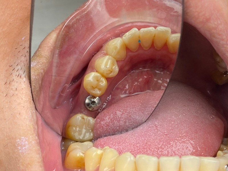 Chăm sóc sau khi trồng Implant 