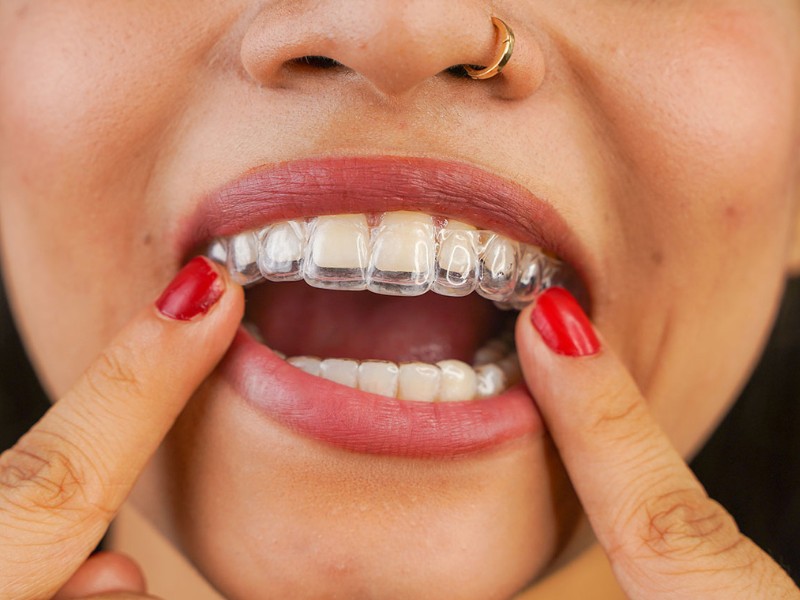 Niềng răng Invisalign có tốt không