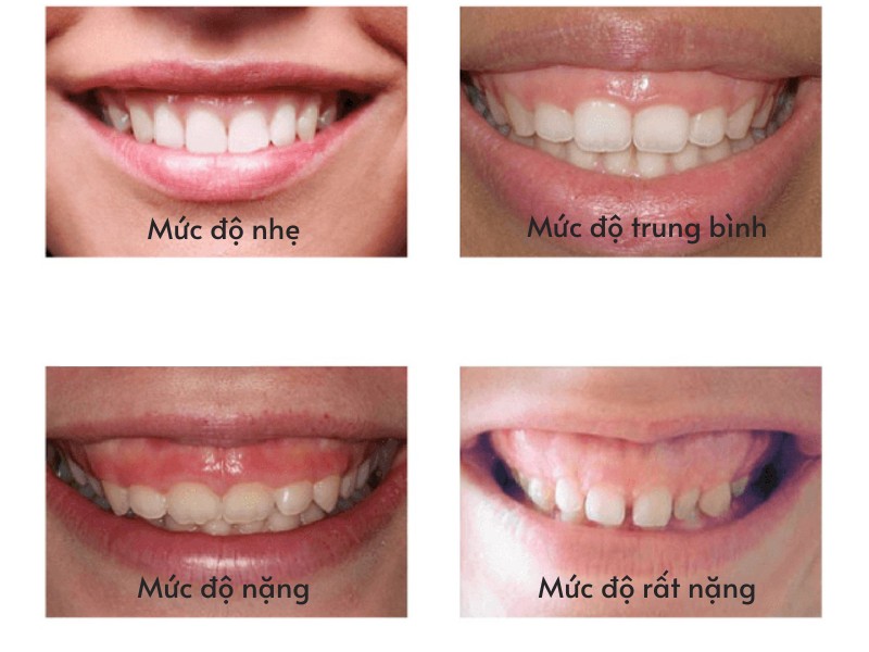 Giải pháp khắc phục cười hở lợi không phẫu thuật