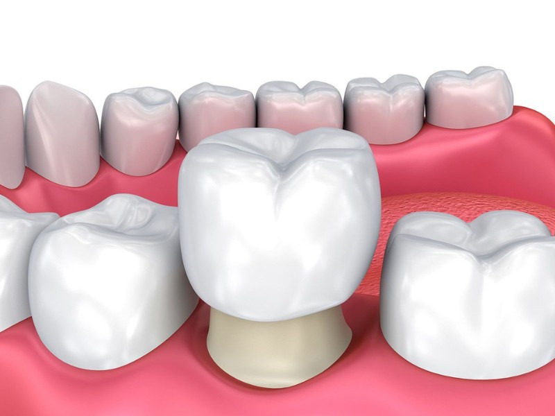 Bọc răng sứ có đau không là một trong những quan tâm hàng đầu khi tìm hiểu về phương pháp này