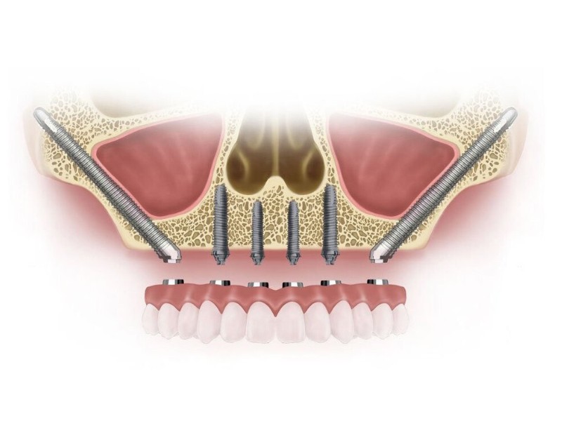 Cấy ghép Implant xương gò má phục hình răng mất cho trường hợp tiêu xương nghiêm trọng