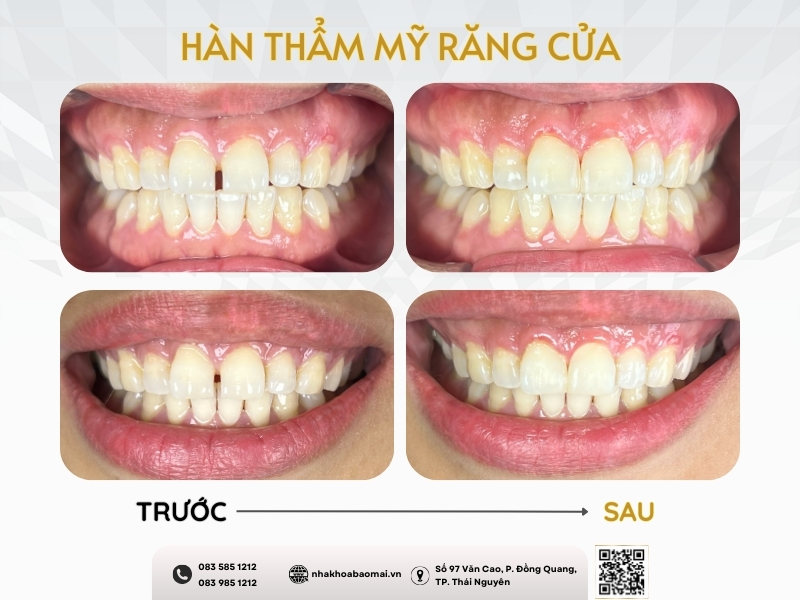 Giá trám răng nha khoa phụ thuộc vào tình trạng răng của mỗi người