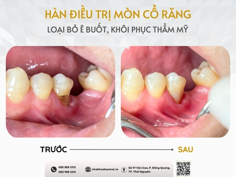 Hàn điều trị mòn cổ răng với trường hợp tổn thương nhẹ chưa lan sâu tới tủy răng