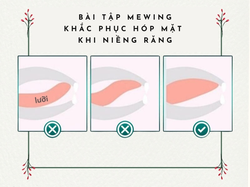 Bài tập Mewing khắc phục tình trạng niềng răng bị hóp mặt