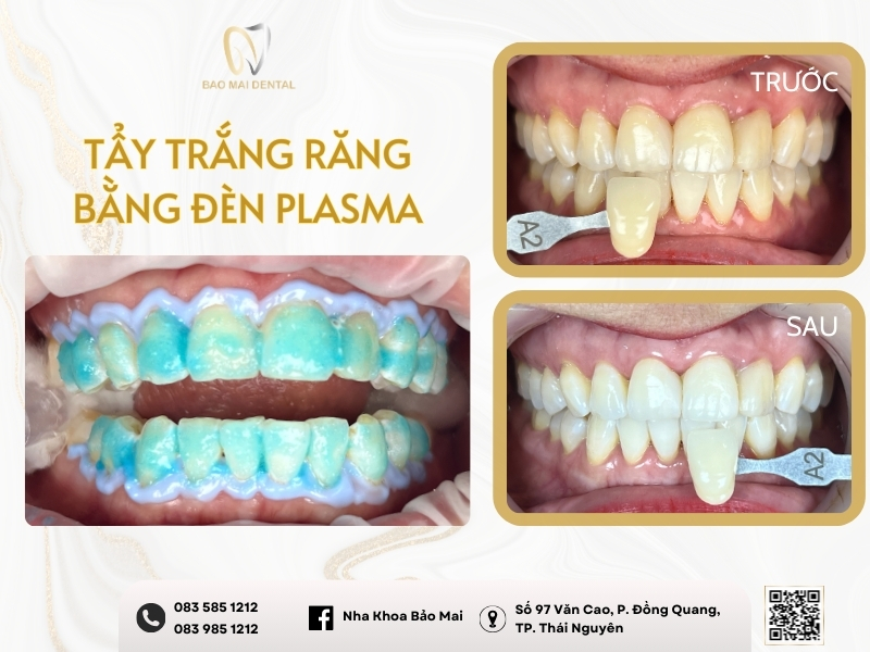 Review tẩy trắng răng bằng đèn Plasma thực tế tại Nha Khoa Bảo Mai