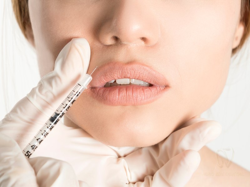 Cách khắc phục cười hở lợi do nhóm cơ môi trên phát triển quá mức bằng tiêm botox