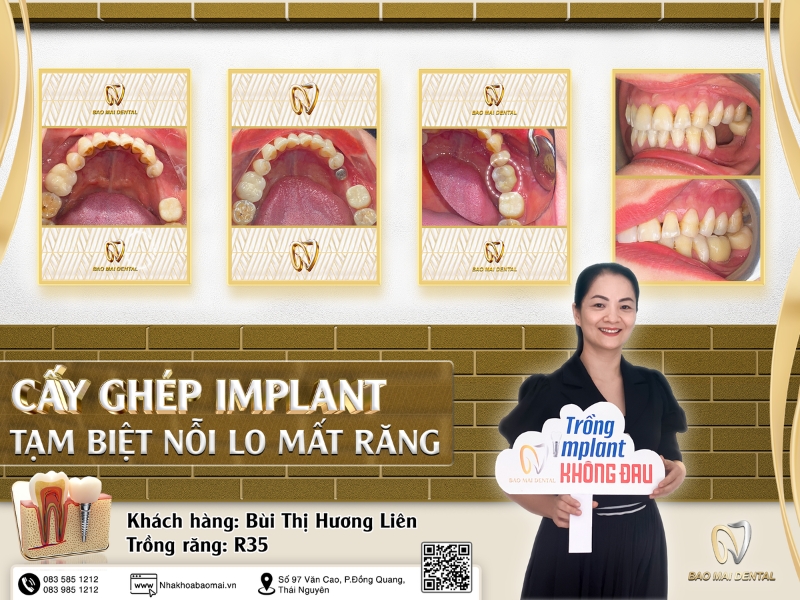 Trồng răng Implant ở đâu tốt