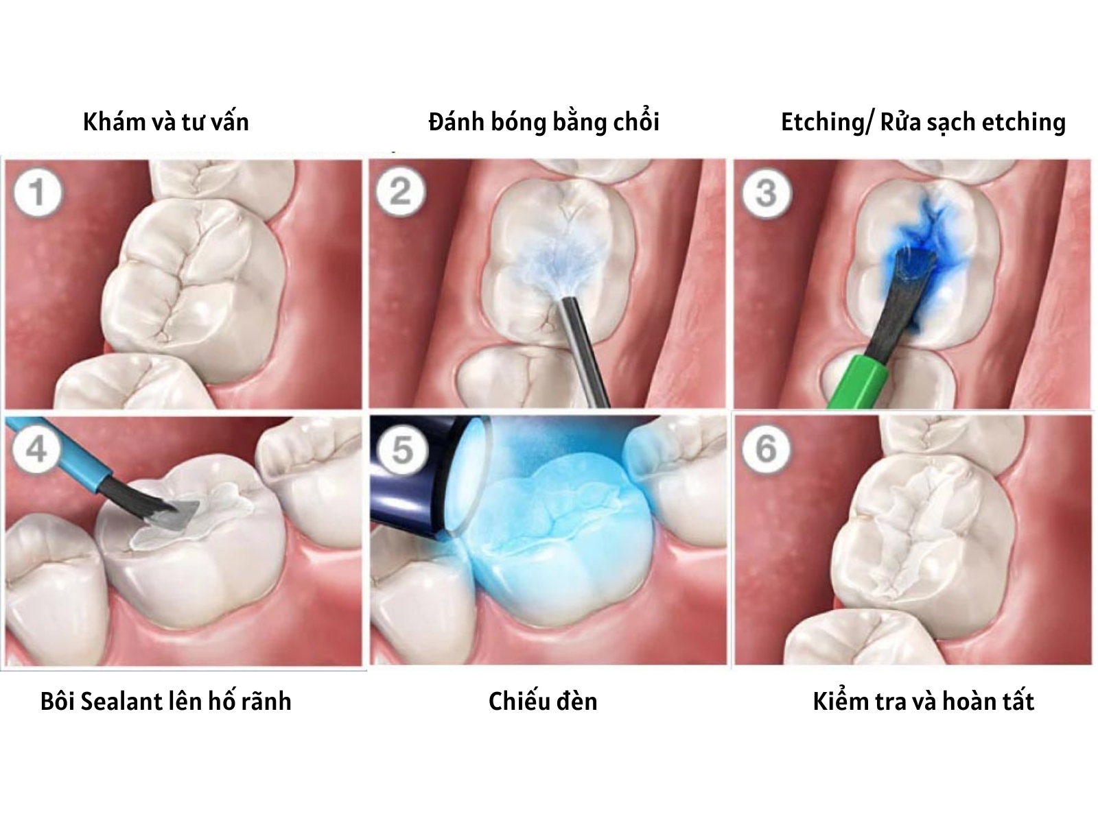 Quy trình sealant trám bít hố rãnh