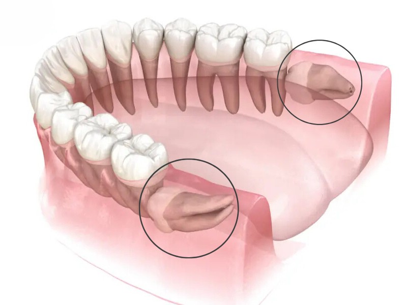 Răng khôn mọc ngang có thể gây ra nhiều biến chứng nguy hiểm 