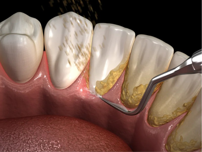 Loại bỏ cao răng mảng bám điều trị bệnh viêm chân răng chuyên sâu tại nha khoa