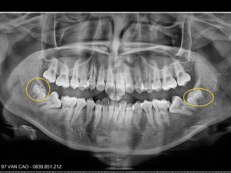 Răng số 8 là răng gì