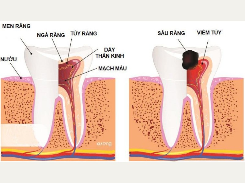 Viêm tủy răng có nguy hiểm không