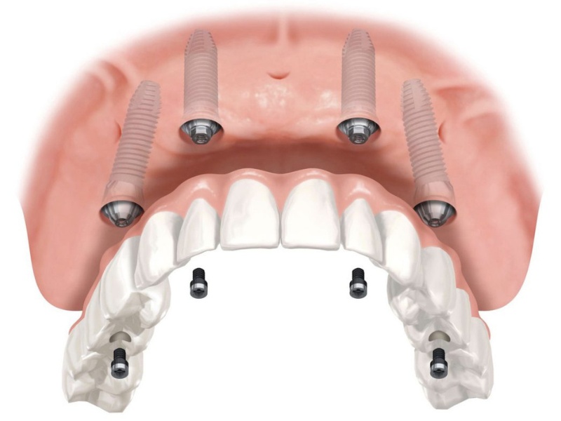 Implant all on 4 rút ngắn thời gian trồng răng cho trường hợp mất răng toàn hàm