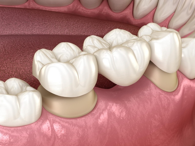 Làm cầu răng sứ có tốt không