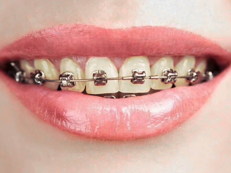 có nên tẩy trắng răng sau khi niềng không