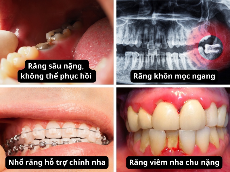 Nhổ răng bằng máy Piezotome