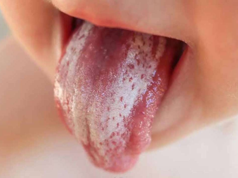 Nấm lưỡi là bệnh lý do Candida gây ra và thường gặp ở trẻ nhỏ