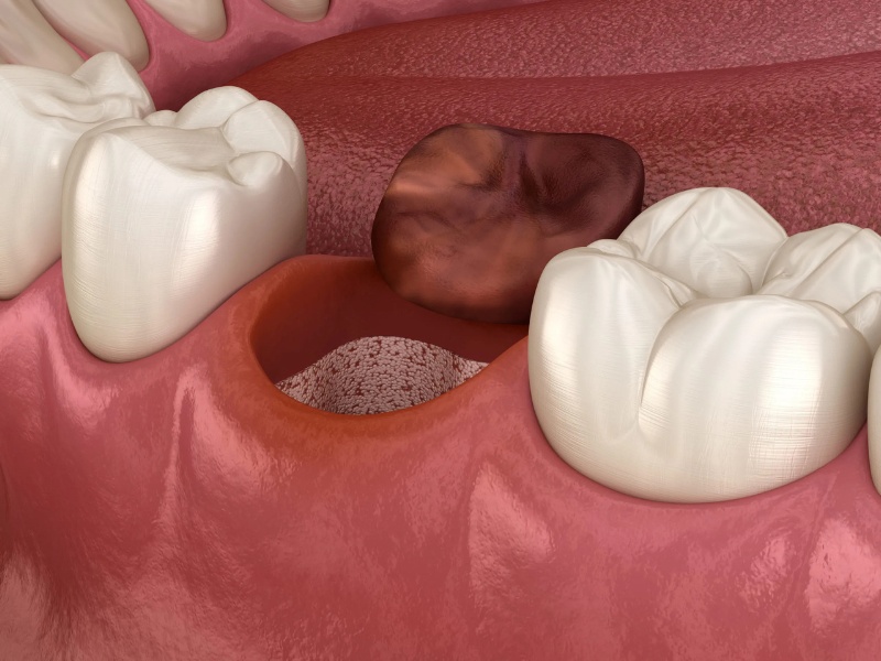 Viêm ổ răng khô thường gặp sau khi nhổ răng vĩnh viễn
