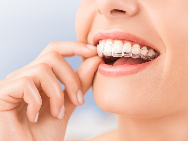 Niềng răng có hôn nhau được không